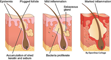 Massage Therapy & Bodywork Local Contraindication: Acne