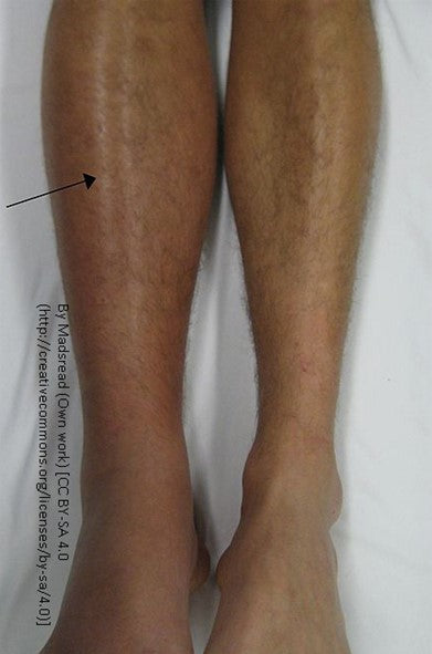 Blood Clot Disorders can be a Bodywork & Massage Therapy Contraindication