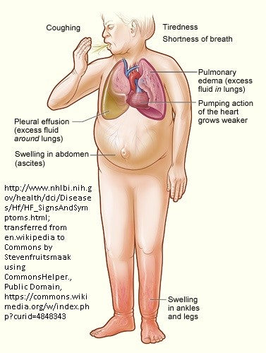 Massage Therapy & Bodywork Precaution or Contraindication: Congestive Heart Failure (CHF)