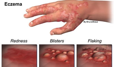 Bodywork and & Massage Therapy Precaution: Eczema with Acute Rash