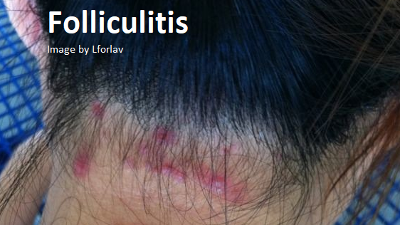 Folliculitis - Massage Therapy, Spa & Salon Service LOCAL Contraindication