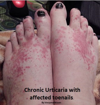 A Brief 101 About Hives (aka Urticaria) for Massage Therapists & Bodyworkers