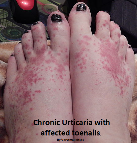 Massage Contraindication: Hives