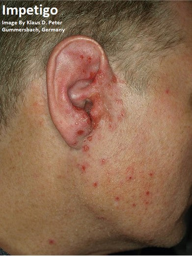 Bodywork & Massage Contraindication: Impetigo