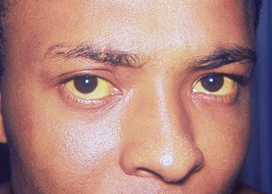 A Brief 101 About Jaundice for Massage Therapists & Bodyworkers