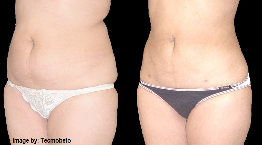 Manual Lymphatic Drainage Post-Abdominoplasty