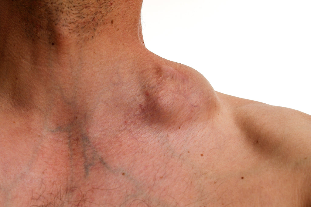 What is that Lump Under the Skin?  What is the Difference Between a Lipoma and Swollen Lymph Node?