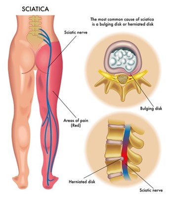 Sciatic Nerve & Piriformis Syndrome Info for LMTs & Bodyworkers