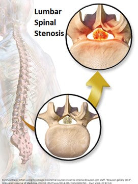 Spinal Stenosis info for Massage Therapists, LMTs & Bodyworkers