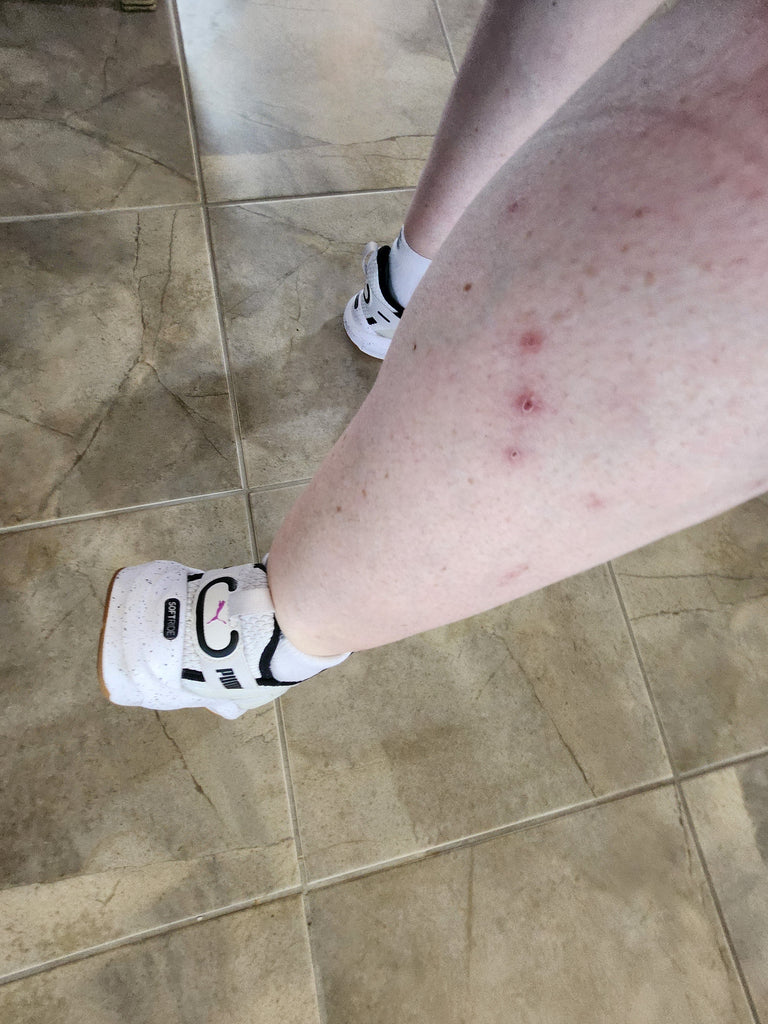Mites and Parasitic Infections with Massage Therapy, Spa or Medical Practice