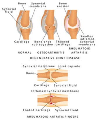 Rheumatoid Arthritis (RA), Osteoarthritis (OA), Fibromyalgia, Gout Info & More for LMTs & Bodyworkers