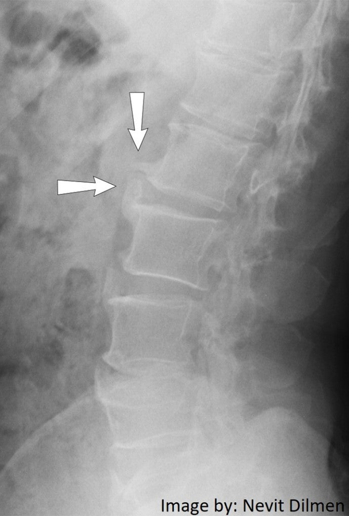 Bone Spurs aka Osteophytes in Massage Therapy Practice