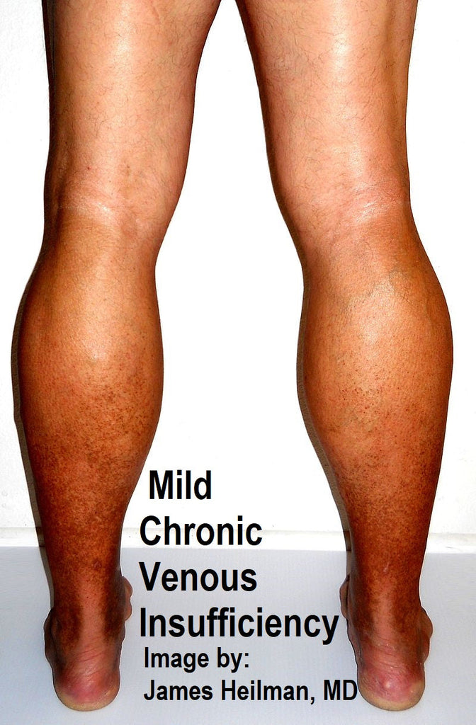 Using Manual Lymphatic Drainage to Treat Chronic Venous Insufficiency (CVI)