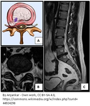 Spinal Vertebrae Disc Injuries, Pinched Nerves, Bulging Herniated Disc Info for Massage Therapists & Bodyworkers