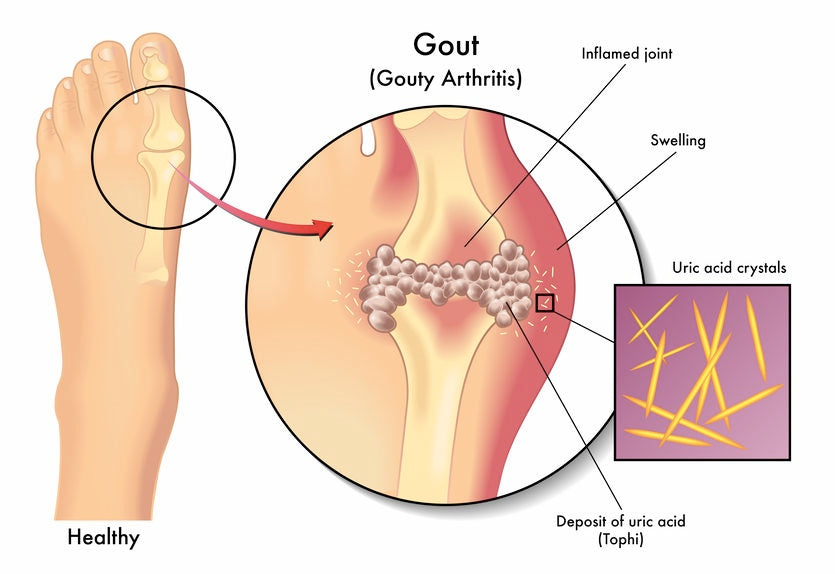Gout - Local Massage Therapy, Pedicure & Spa Service Contraindication
