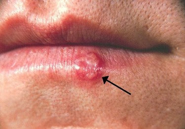A Brief 101 About Herpes for Massage Therapists & Bodyworkers