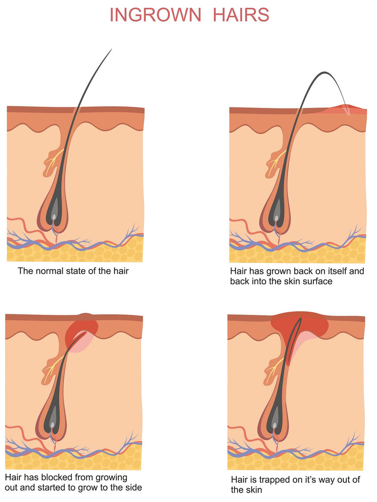 Ingrown Hair - What is it?