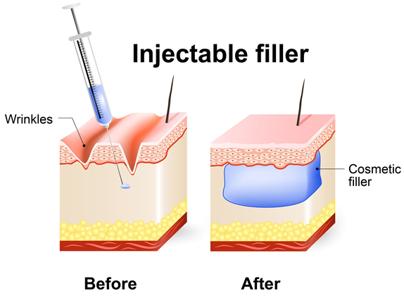 Massage Therapy and Other Service Appointment Contraindications with Cosmetic and Dermal Fillers