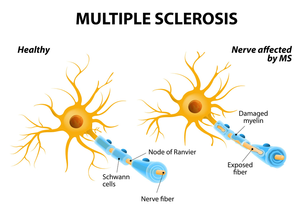 Multiple Sclerosis Info for Massage Therapists & Bodyworkers