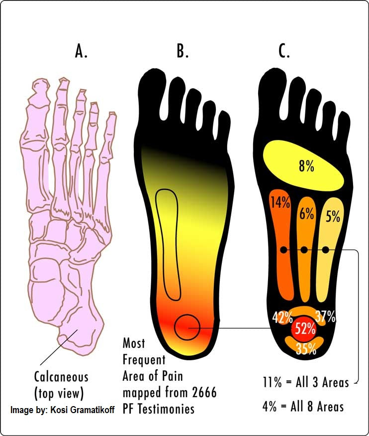 Working with Chronic Plantar Fasciitis - Massage Therapy Instructor Demonstration