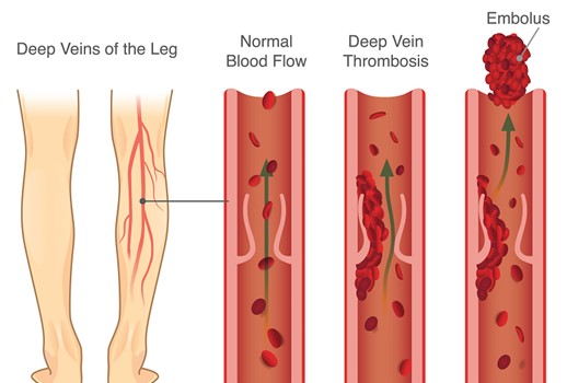 Pulmonary Embolism (PE) is a Bodywork and Massage Therapy Contraindication