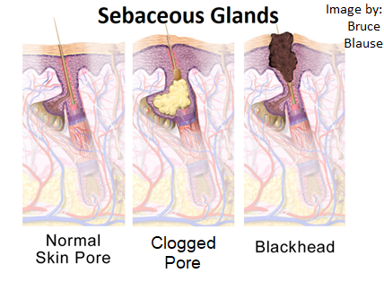 Sebaceous Cyst & Glands 101 for Massage Therapist, Spa & Salon Service Providers
