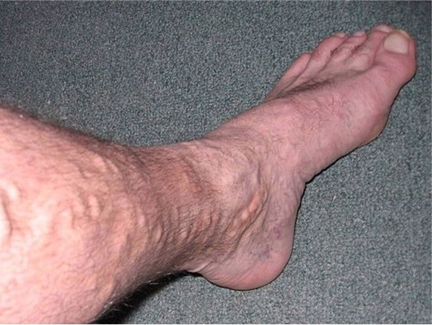 Varicose Veins are a Local Massage Therapy & Bodywork Contraindication